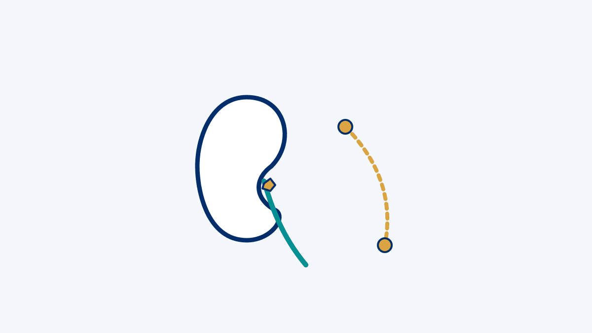 Kidney Stone Symptoms medical diagram