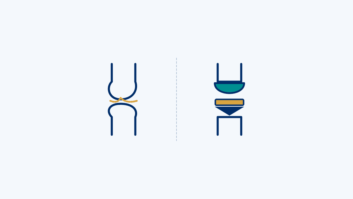When Is Knee Replacement Needed? medical diagram