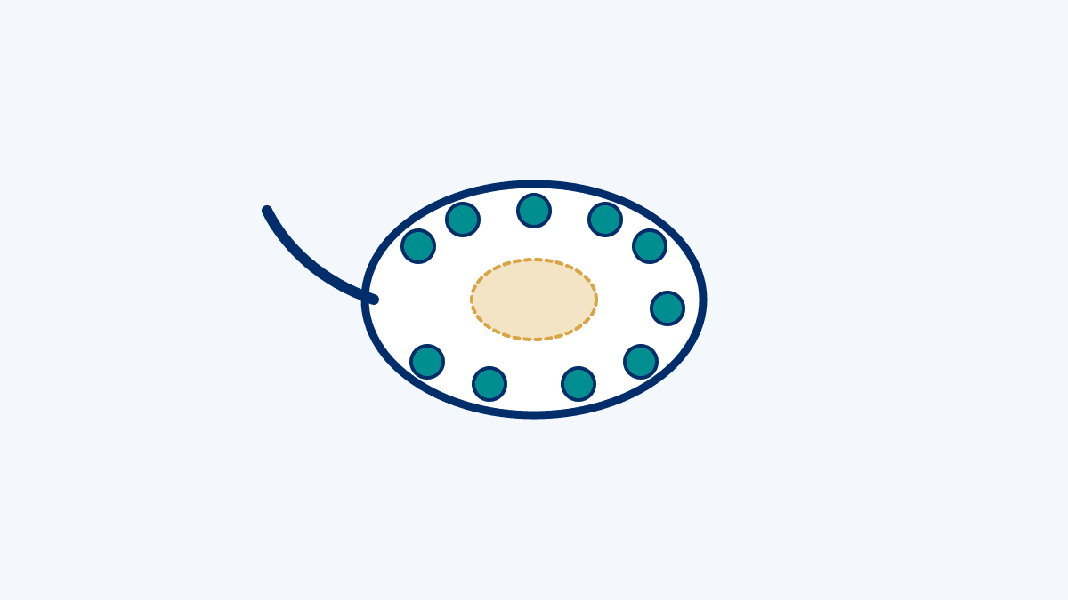 PCOS Symptoms medical diagram